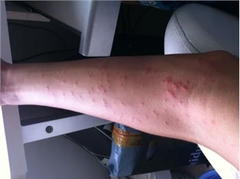 Come trattare l'orticaria?